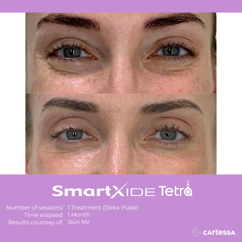 Before and after Tetra Co2 Laser Treatment eye area