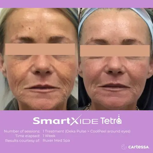 Before and after Tetra Co2 Laser Treatment anti-aging