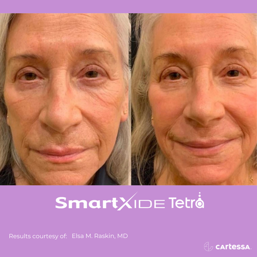 Before and after Tetra Co2 Laser Treatment face