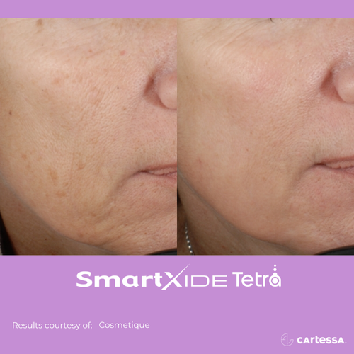 Before and after Tetra Co2 Laser Treatment cheek