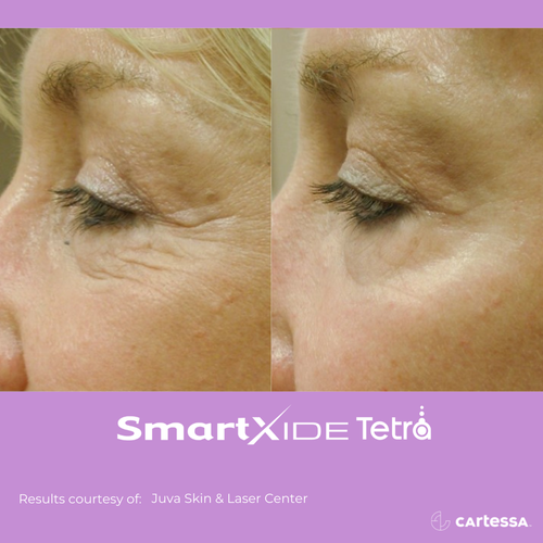 Before and after Tetra Co2 Laser Treatment eye area