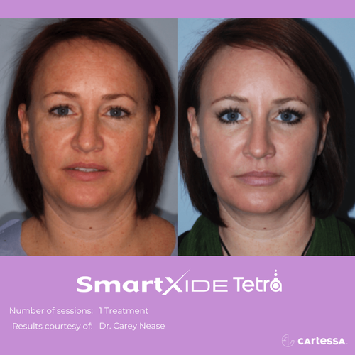 Before and after Tetra Co2 Laser Treatment