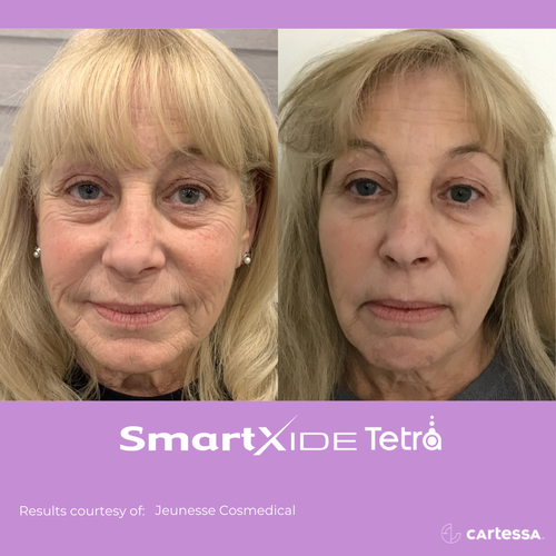 Before and after Tetra Co2 Laser Treatment