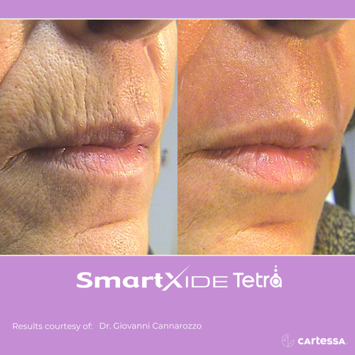 Before and after Tetra Co2 Laser Treatment mouth
