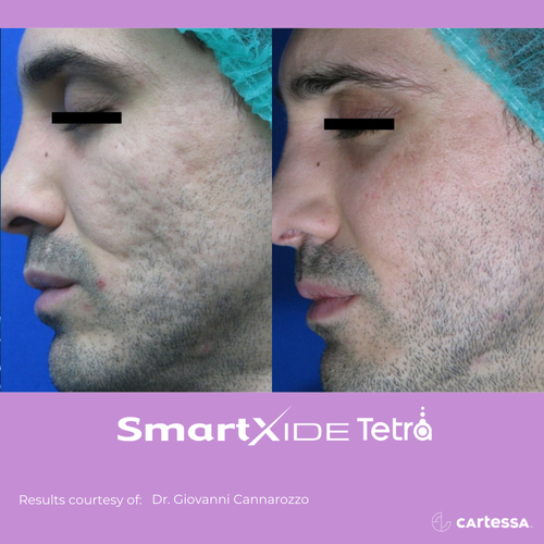 Before and after Tetra Co2 Laser Treatment acne scars