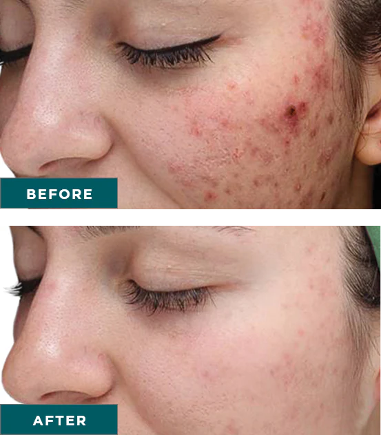 before and after chemical peel showing a reduction of acne and acne scars
