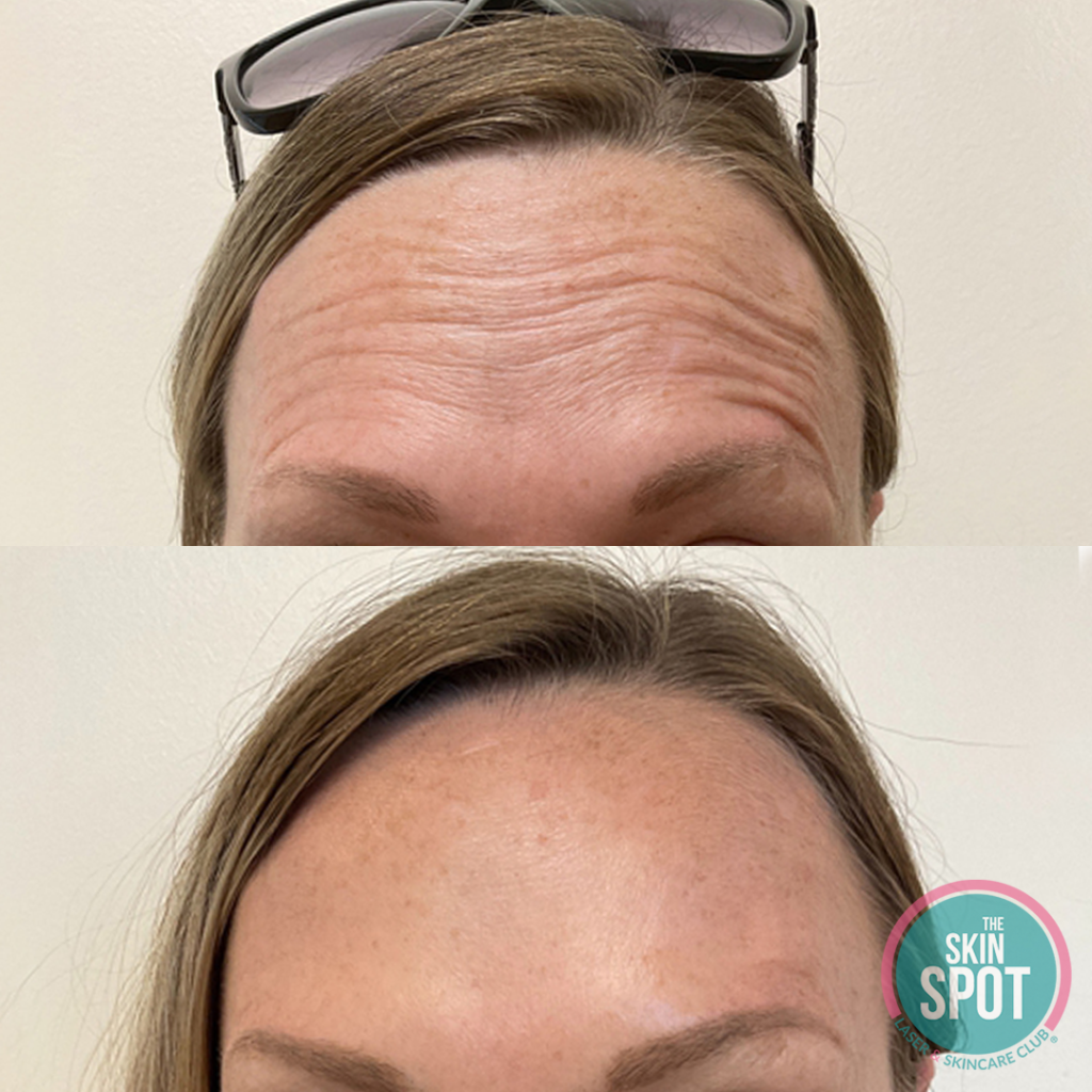 before and after botox for forehead wrinkles Cosmetic Botox injections near Cape Coral and Fort Myers for wrinkle reduction and facial rejuvenation