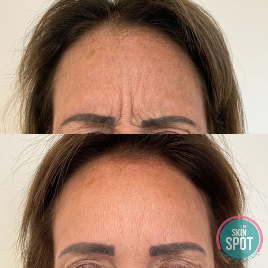 before and after botox for forehead wrinkles Cosmetic Botox injections near Cape Coral and Fort Myers for wrinkle reduction and facial rejuvenation