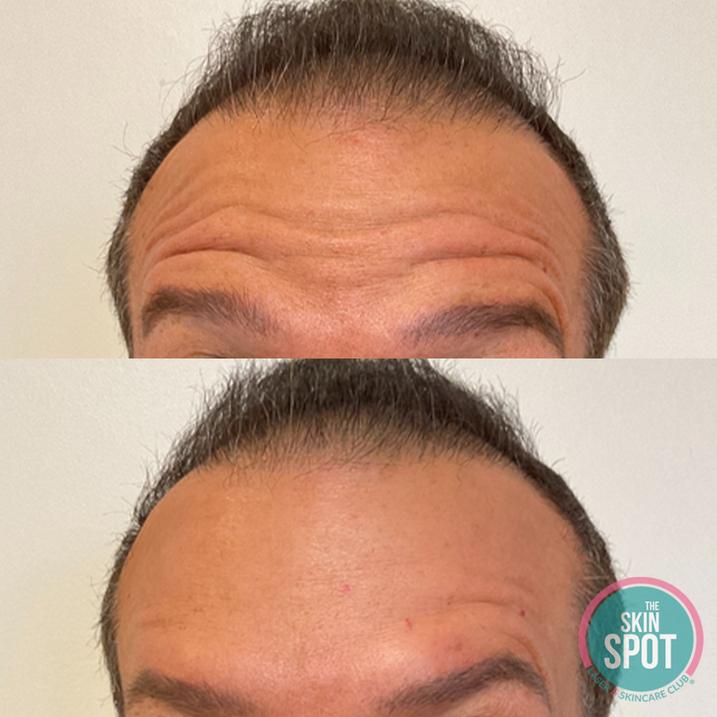 before and after botox injections to smooth wrinkles on forehead