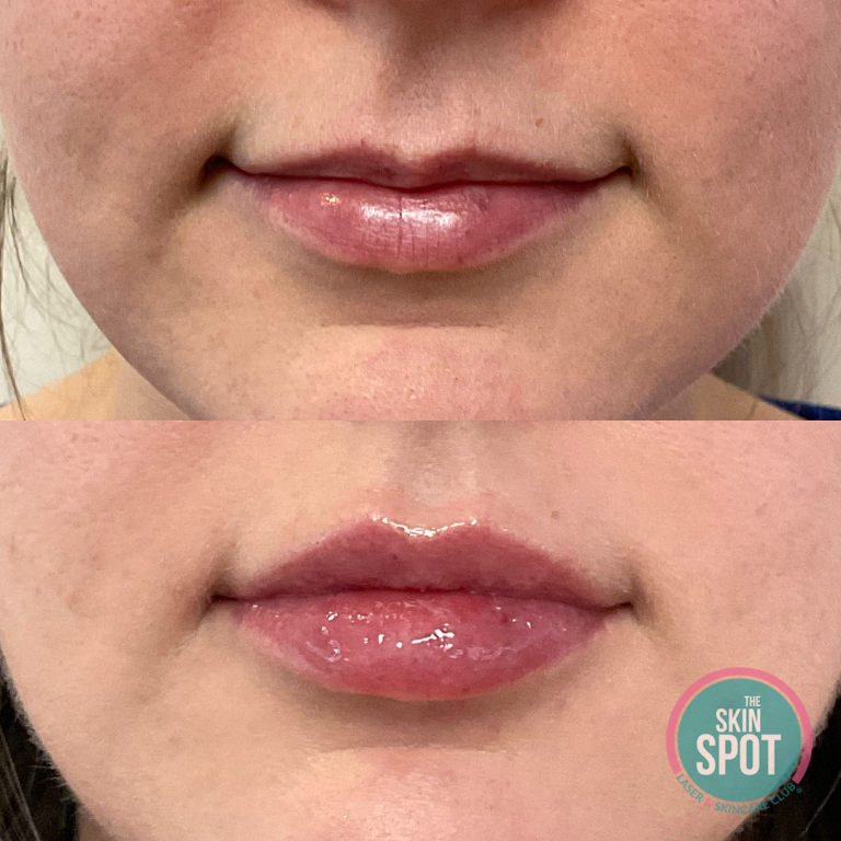 before and after lip filler Lip filler and facial contouring treatments near Cape Coral and Fort Myers