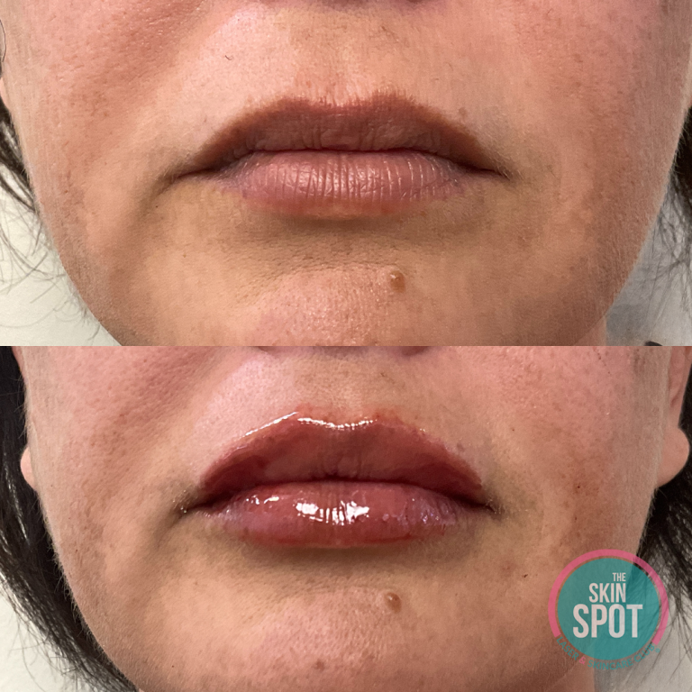 before and after lip filler Lip filler and facial contouring treatments near Cape Coral and Fort Myers