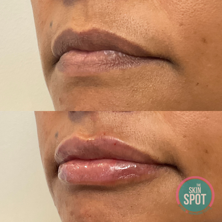before and after lip filler Lip filler and facial contouring treatments near Cape Coral and Fort Myers