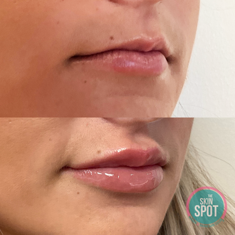 before and after lip filler