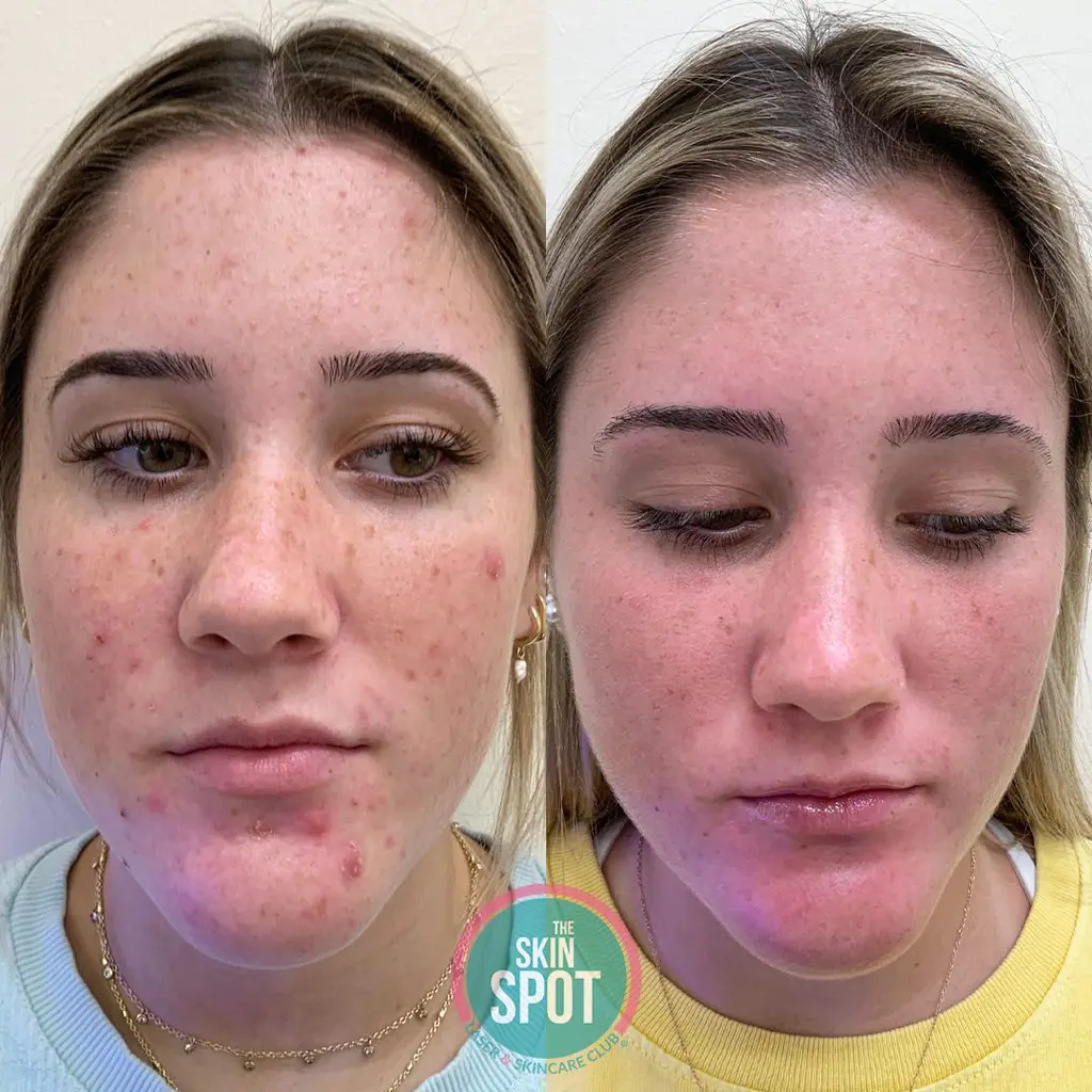 Before and after of woman's face looking significantly better after acne treatments.