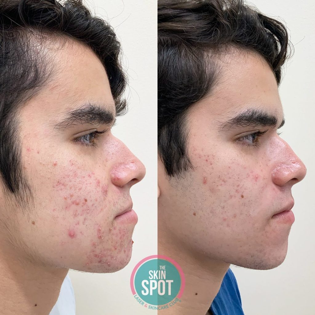 Before and after of mans face looking significantly better after acne treatments.