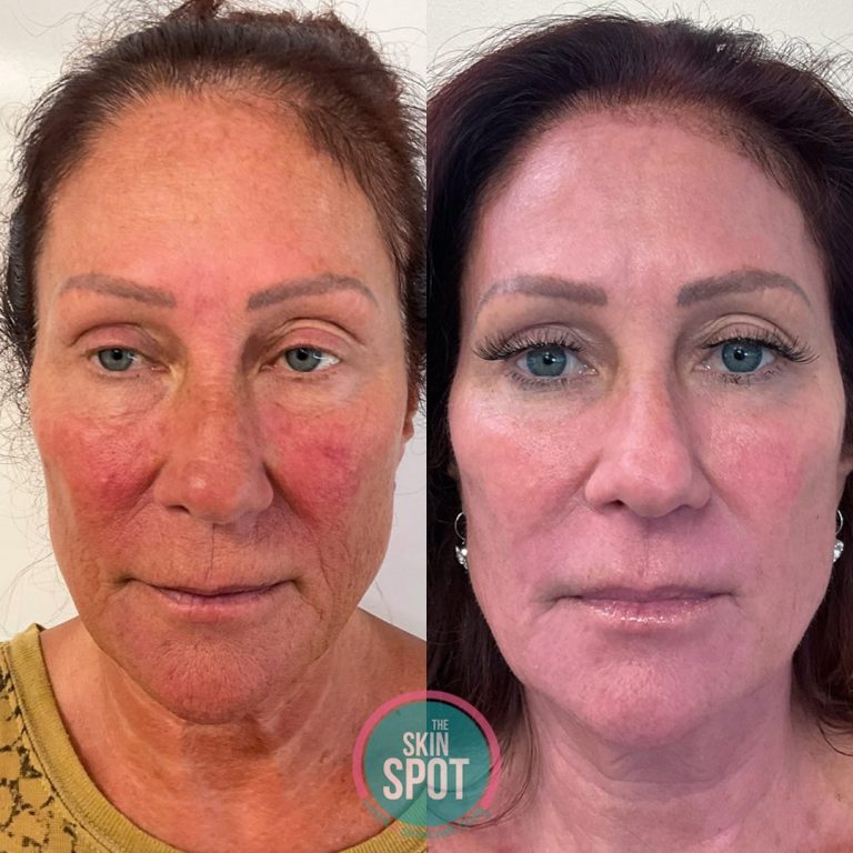 before and after of womans face looking smooth and bright after tetra co2 laser treatment.