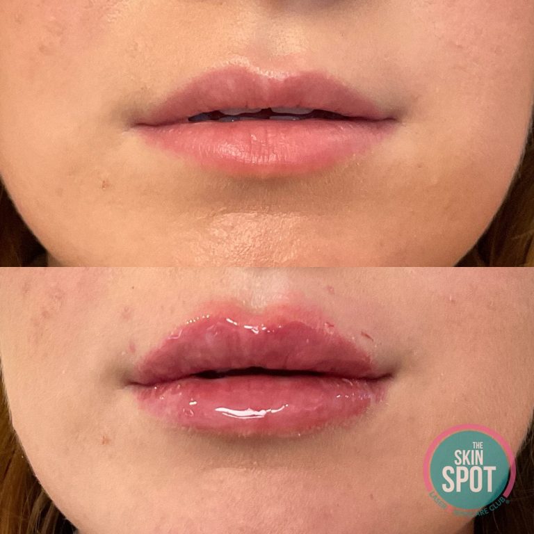 Before and after of plump lips after dermal filler.