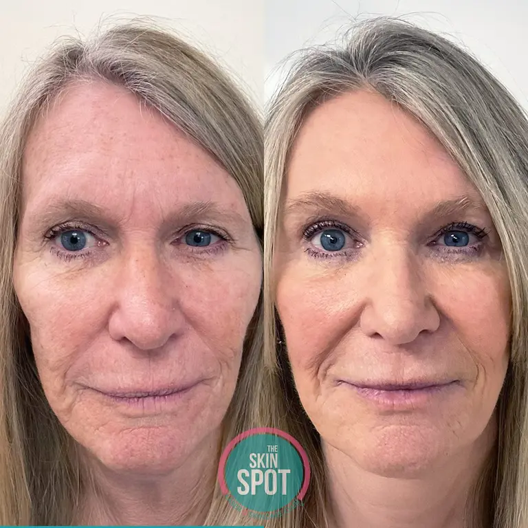 before and after of woman looking youthful after tetra co2 laser treatment.