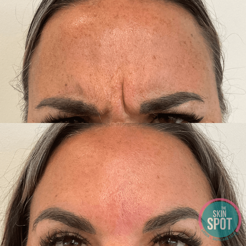 Expert Botox injections in Fort Myers med spa