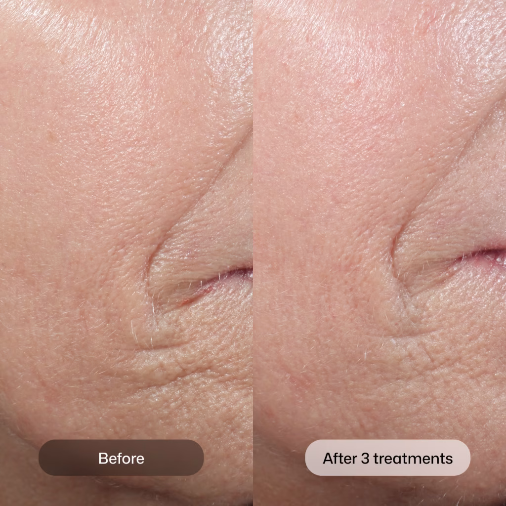 NEW AT SKIN SPOT LASER CLUB: Revision Skincare® D·E·J BioStim™ Treatment