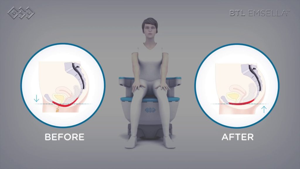 emsella treatment