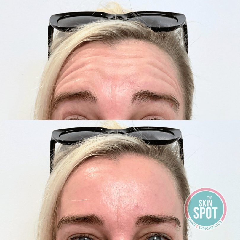 Xeomin in Cape Coral, FL xeomin injections near me wrinkle relaxers cape coral skin spot laser club