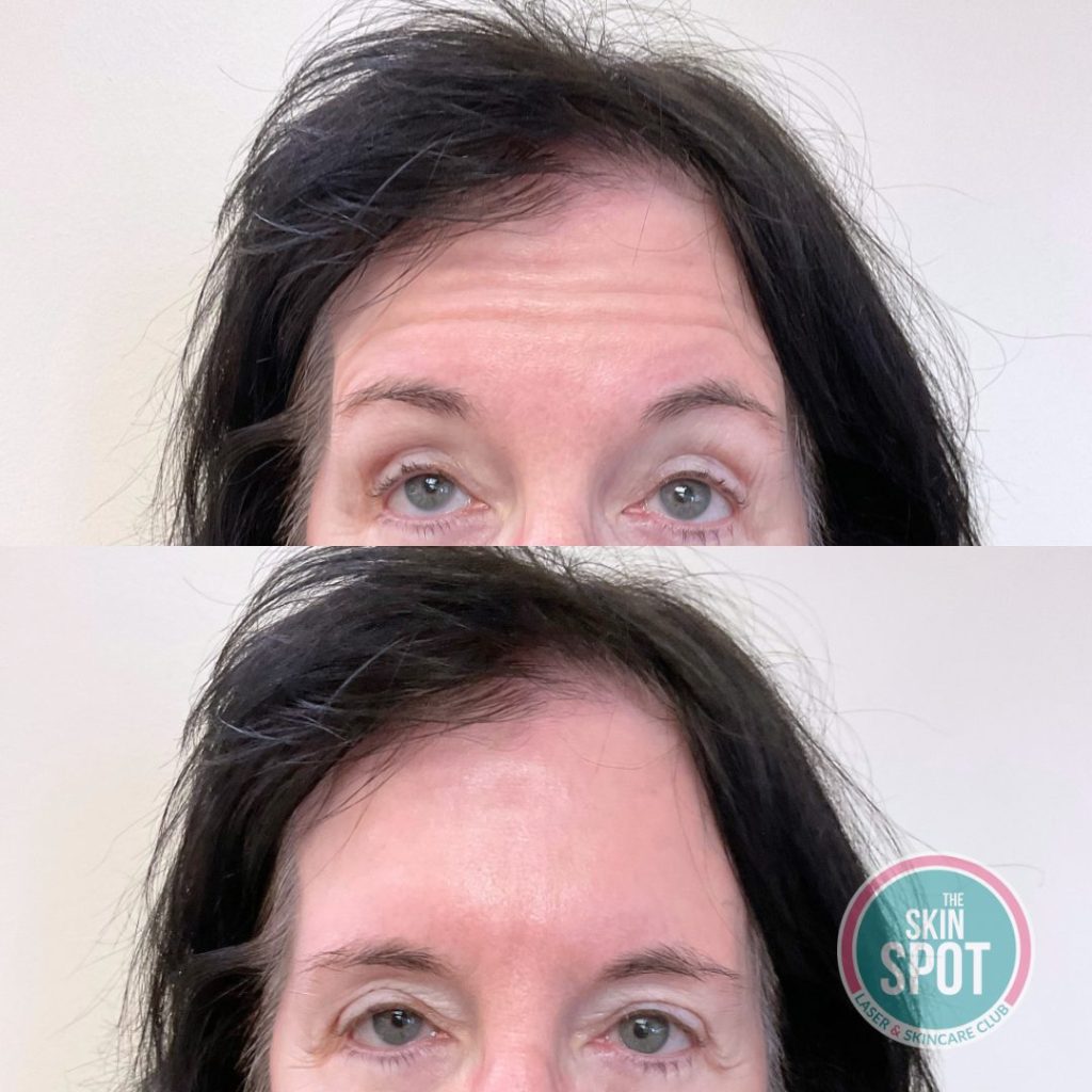 Dysport in cape coral and fort myers | Dysport near me | Dysport injections | Anti-aging treatments fort myers | Wrinkle relaxers cape coral