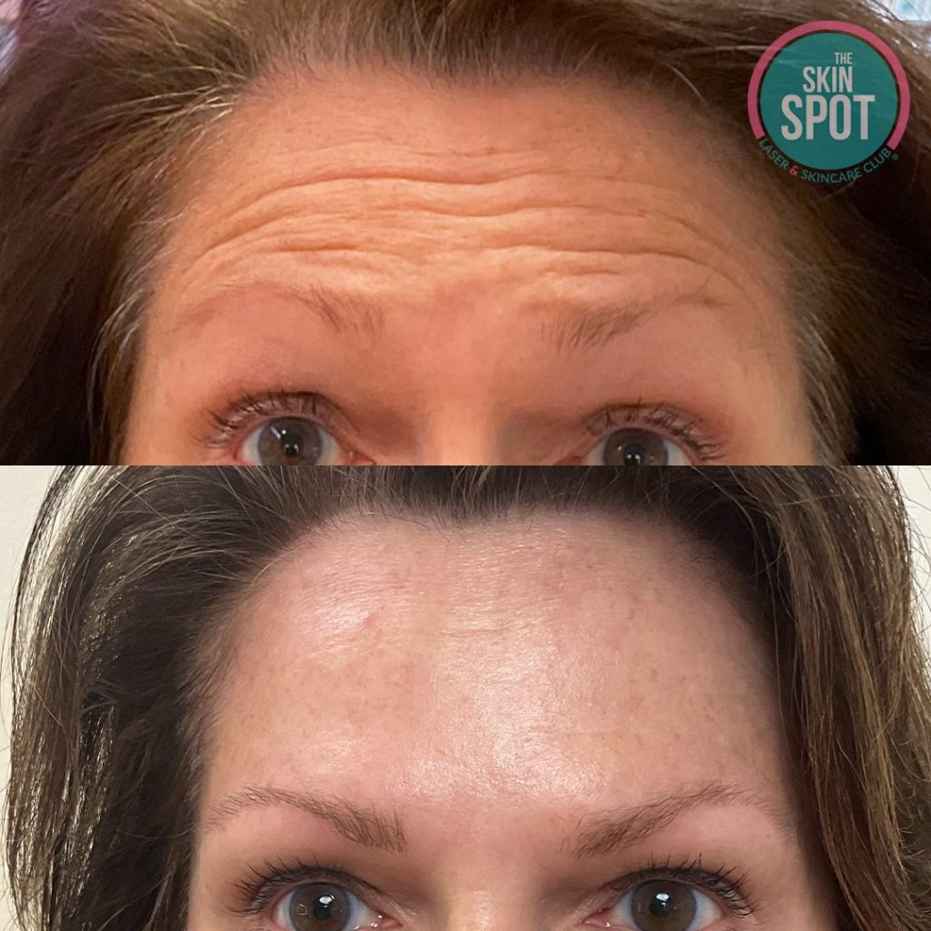 Botox Before and after skin spot laser club